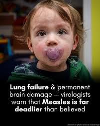Virologists warn that measles is far more dangerous than most people think.  The 2025 measles outbreak in Texas, New Mexico, and Oklahoma has reignited  concern over a virus many Americans consider a