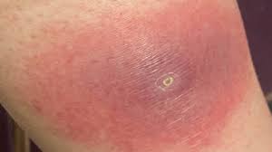 Image result for spinne biss haut reaktion