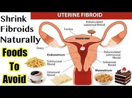 Fibroid Shrinking Foods Foods To Avoid To Shrink Fibroids Youtube In 2020 Fibroid Diet Fibroids Fibroids Shrink