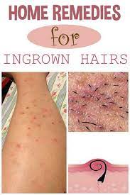 Folliculitis occurs when a hair follicle gets infected. Folliculitis Laser Hair Removal And Varicose Veins