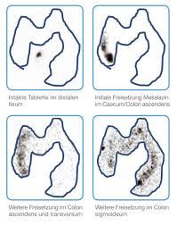 In casp, a stent is inserted into the ascending colon, which generates a septic focus. Opticore Technologie Tillotts De