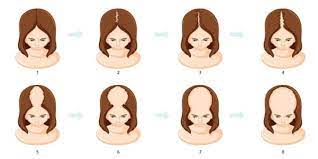 Hair loss can alert us to everything from hormonal imbalances to nutritional deficiencies; Female Pattern Baldness Causes And Effects Of Female Alopecia