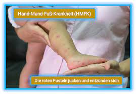 Hand Fuss Mund Krankheit Hfmk So Schutzt Du Dein Baby
