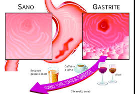 Asma da reflusso gastroesofageo, cosa fare? Asma Tosse E Denti Rovinati Puo Essere Il Reflusso Gastroesofageo Gazzetta Di Parma