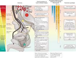 Image result for Radical Prostatectomy