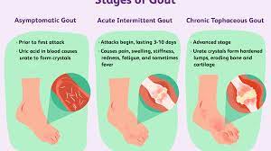 It is soluble in it, mainly in the form of urate and in small quantities as uric acid. Hyperuricemia And Kidney Disease