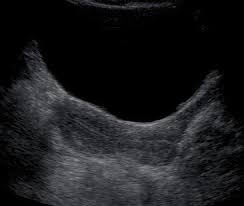Wk 1 L2 Transabd Normal Ut Ultrasound Sonography Ultrasound Uterus