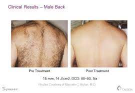 We have extensive experience in skin, laser & hair transplantation. Laser Hair Removal In Zirakpur Renovin Skin Care Laser Hair Removal In Chandigarh Laser