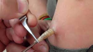 10:01 #botfly #removal #warble botfly maggots botfly botfly maggot removal warning dermatobia hominis mangoworms botfly larva di dalam burung mangoworms removal botfly removal berne berne em passarinho mangoworms bird larvae. Botfly Maggot Removal Mango Worms In A Girl Youtube