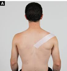 Read below for more information on causes and how to relieve pain in the shoulder blade. Rock Climbing Injury Tips Shoulder Taping The Climbing Doctor