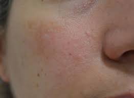 ¿es el melasma una enfermedad grave? Efectividad Del Tratamiento Combinado De Lesiones De Melasma Con Compromiso Vascular Utilizando Laser 1064 Nd Yag Modo Q Switched Y Vbeam En Pacientes Femeninas Venezolanas Piel L Latinoamericana