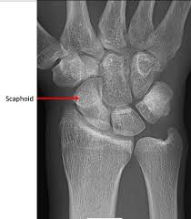 Image result for Scaphoid Fracture