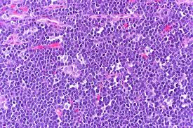 Burkitt Lymphoma With The Starry Sky Appearance White Areas Are The Macrophages Which Are The Stars And The Dark Cells Burkitt S Lymphoma Lymphoma Neon Signs