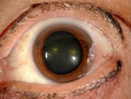 Image result for lesion sclera