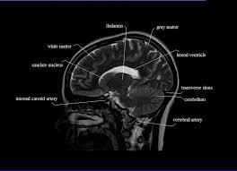 Mri Sagittal Cross Sectional Anatomy Of Brain Image 8 Brain Anatomy Mri Brain Brain Images