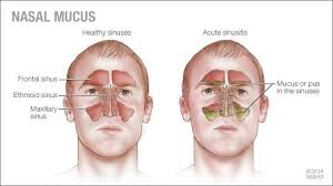 Mayo Clinic Q And A Nasal Mucus Color What Does It Mean