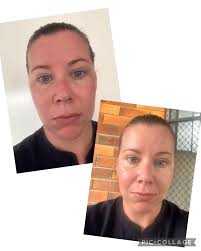 Sunday spot treatment recommendation from skincare specialist