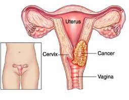 As the tumour becomes larger, symptoms include Cervical Cancer Physiopedia