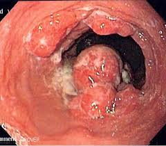 Throat cancer can make it painful to eat and difficult to swallow. Esophageal Cancer Wikipedia