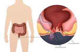 Blood in the stool may be less evident, and is sometimes invisible, or. Rectal Bleeding Blood In Stools Health