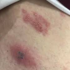 Majoritatea oamenilor primesc zona zoster o dată, dar este posibil să o obțină de 2 sau 3 ori mai mult. Pdf Herpes Zoster Co Infection In An Immunocompetent Patient With Covid 19