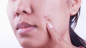 A new mole that looks different to its surrounding moles may be the start of a melanoma. Can Skin Cancer Look Like A Pimple