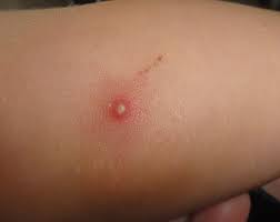 It is very common in children and adolescents. Molluscum Contagiosum All About Nothing