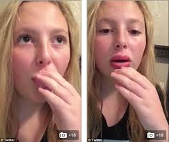 Trào lưu kì quái: Hít chai làm môi sưng vù