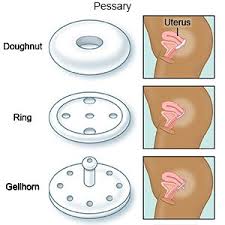 Image result for Pessary