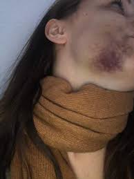 Anhand ihrer form und lage kann der zahnarzt allerdings abschätzen. Hamatom Nach Weisheitszahn Op Gesundheit Und Medizin Weisheitszahne