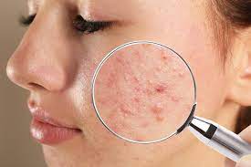 Que Puede Revelar El Acne Sobre Tu Salud Mejor Con Salud