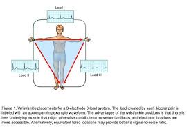 What Is The Correct Electrode Placement For A Conventional
