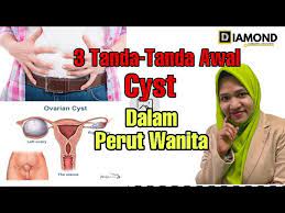 Akan tetapi berkenaan dengan kapan terjadinya, (hari, tanggal, bulan dan. 3 Tanda Tanda Awal Cyst Dalam Perut Wanita Youtube