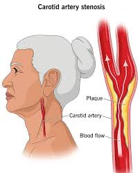 Chiropractic care improves swim performance in male athlete