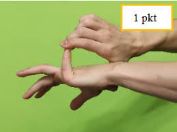 Możliwy jest przeprost w stawie kolanowym, łokciowym, bierne przyciąganie kciuka do przedramienia, nasilone zgięcie stóp i inne anomalie świadczące o nadmiernej ruchomości w stawach). Wiotkosc Stawow Czy Przeprost Kolan Jest Zly Fizjoklinika