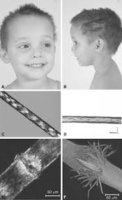 Emaciated add to list share. Emaciation An Overview Sciencedirect Topics
