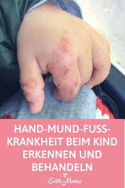 Hand Mund Fuss Krankheit Beim Kind Erkennen Und Behandeln Mund Fuss Krankheit Hand Mund Fuss Kinder