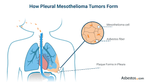We did not find results for: Pleural Mesothelioma Causes Symptoms Treatment And Top Doctors