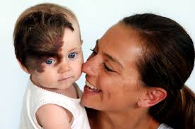 Wollongong girl Ruby Ashby faces surgery to remove a rare birthmark