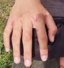 Image result for Scabies