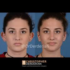 Modern clinic, experienced & uk certified surgeons, 24/7 personal assistance. Otoplasty Ear Surgery Dallas Plastic Surgeon Specializing In Rhinoplasty Septoplasty Cleft Rhinoplasty Cleft Lip Revision And Ear Surgery