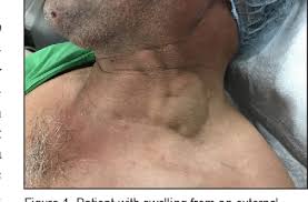 Pdf Image Diagnosis Classic External Jugular Vein Aneurysm Semantic Scholar Jugular vein distention or jvd is when the increased pressure of the superior vena cava causes the jugular vein to bulge, making it most visible on the right side of a person's neck.