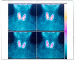 Here's what you need to know about thyroid nodules and how concerned you because many thyroid nodules don't have symptoms, people may not even know they're there. What S A Thyroid Nodule And Is It Cancerous Hartford Healthcare Ct