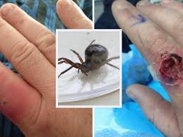 According to the nhs, to treat a bite you must False Widow Spider Bite Nearly Cost Joiner His Finger As He Watched Netflix Chronicle Live