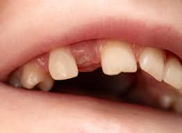 Image result for Dry Socket