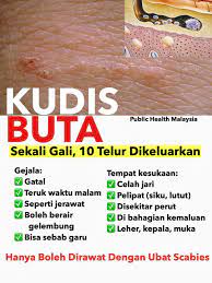 This page provides all possible translations of the word buta in the english language. Kudis Buta Ruam Ni Gatal Sungguh Klinik Putramedic Facebook