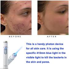 Blue Light Therapy Treatment Pen Life Changing Products