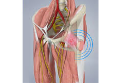 Image result for Snapping Hip