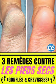 Remède de grand mère qui marche. Pieds Abimes 3 Remedes Contre Les Pieds Secs Gonfles Et Fendilles