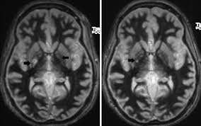 Image result for Pallidotomy